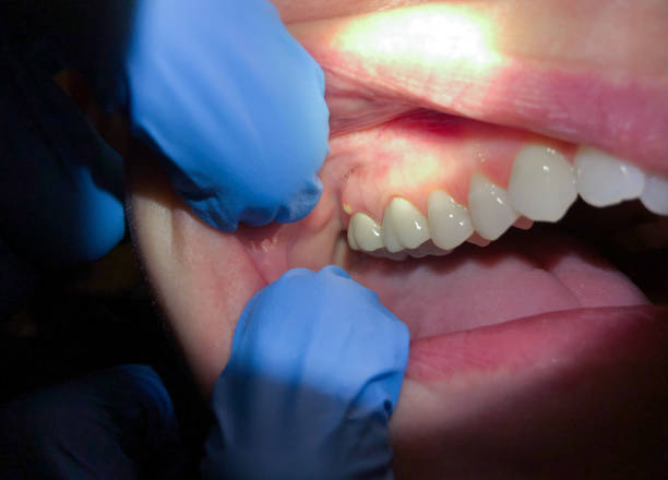 Best Emergency Broken Tooth Repair in Cookeville, TN